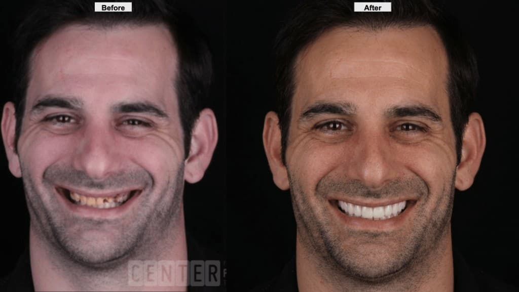 Before and after smile makeover: natural teeth compared to bright uniform veneers