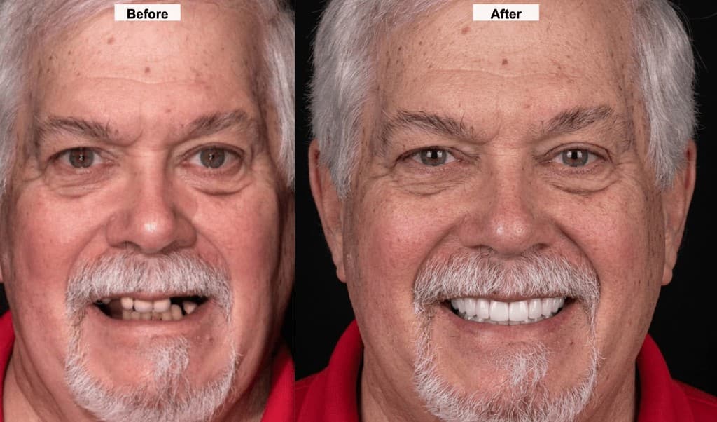 Before and after dental implants or full arch restoration on upper teeth